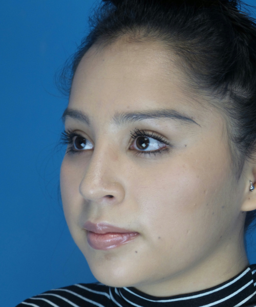 after rhinoplasty female patient left angle view case 2308