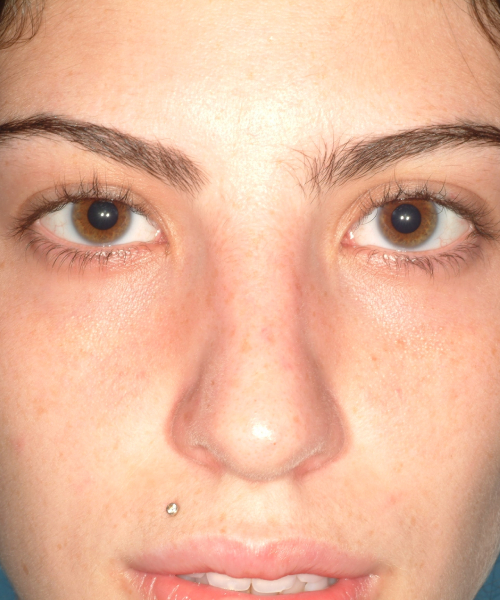 before rhinoplasty female patient front view case 2327