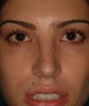 after rhinoplasty female patient front view case 2327