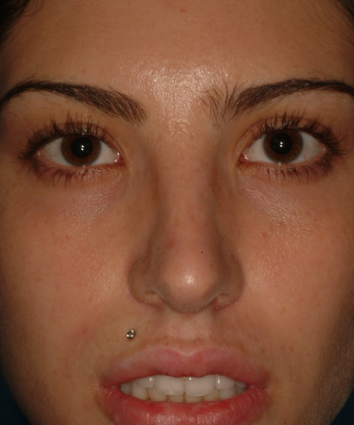 after rhinoplasty female patient front view case 2327
