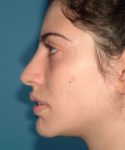 before rhinoplasty female patient left side view case 2327