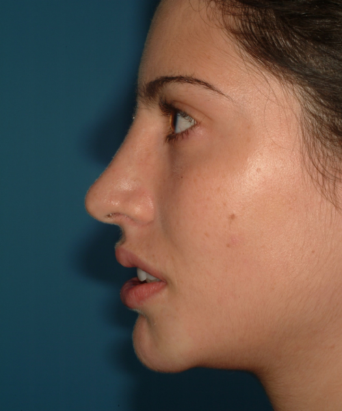 after rhinoplasty female patient left side view case 2327