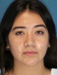 after rhinoplasty female patient front view case 2696