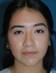 before rhinoplasty female patient front view case 2696