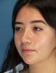 after rhinoplasty female patient left angle view case 2696