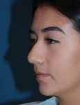 before rhinoplasty female patient left angle view case 2696
