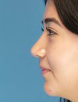 after rhinoplasty female patient left side view case 2696