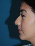 before rhinoplasty female patient left side view case 2696