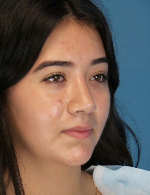 after rhinoplasty female patient right angle view case 2696