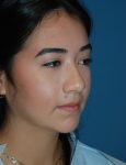 before rhinoplasty female patient right angle view case 2696