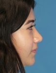 after rhinoplasty female patient right side view case 2696