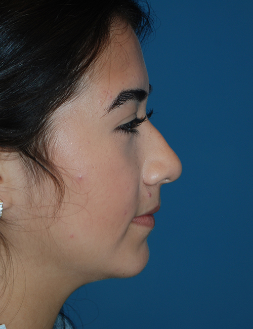 before rhinoplasty female patient right side view case 2696