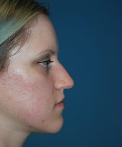before rhinoplasty right side view case 4098 | Crispin Plastic Surgery Atlanta, GA