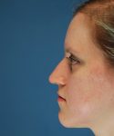 before rhinoplasty left side view case 4098 | Crispin Plastic Surgery Atlanta, GA