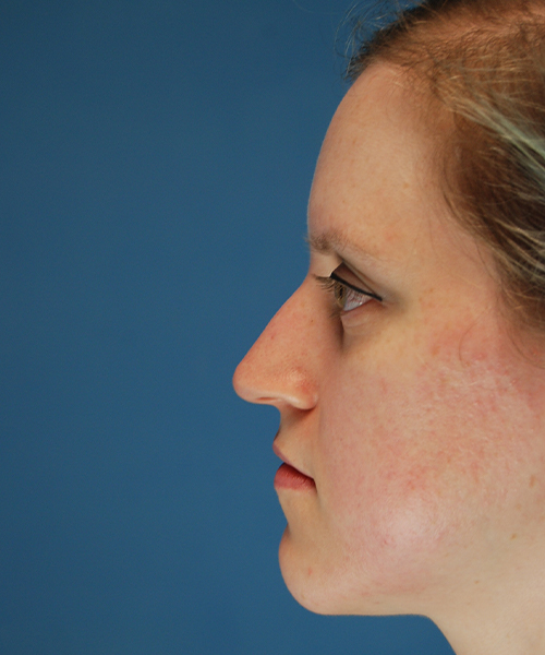 before rhinoplasty left side view case 4098 | Crispin Plastic Surgery Atlanta, GA