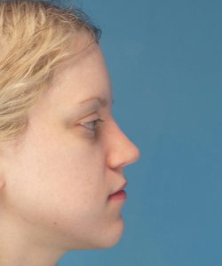after rhinoplasty right side view case 4098 | Crispin Plastic Surgery Atlanta, GA