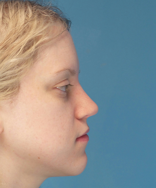 after rhinoplasty right side view case 4098 | Crispin Plastic Surgery Atlanta, GA