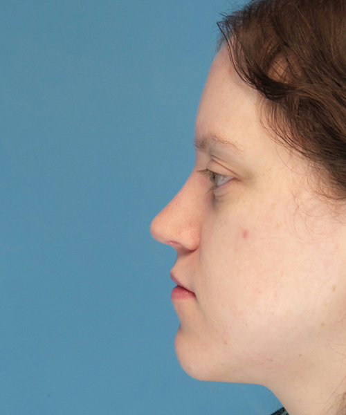after rhinoplasty left side view case 4098 | Crispin Plastic Surgery Atlanta, GA