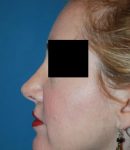 after rhinoplasty female patient left side view case 4874 Crispin Plastic Surgery Atlanta, GA