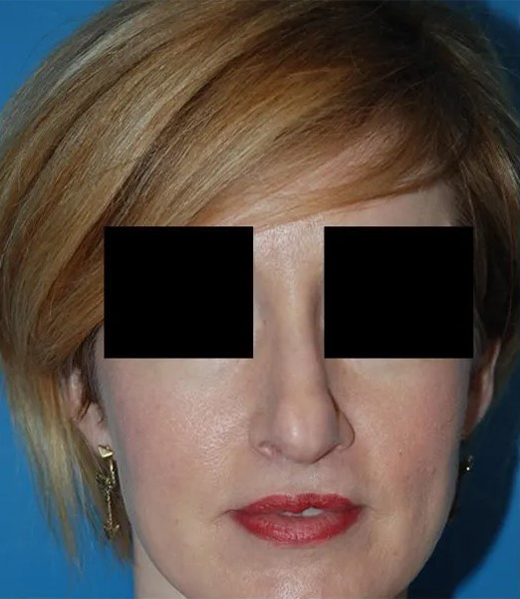 before rhinoplasty female patient front view case 4874 Crispin Plastic Surgery Atlanta, GA