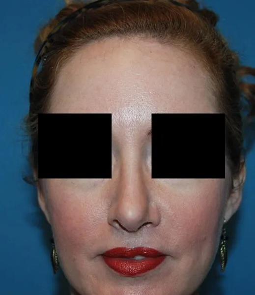after rhinoplasty female patient front view case 4874 Crispin Plastic Surgery Atlanta, GA
