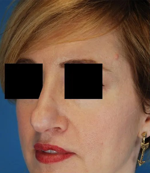 before rhinoplasty female patient front diagonal view case 4874 Crispin Plastic Surgery Atlanta, GA