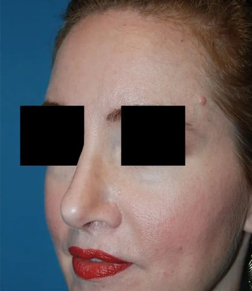 after rhinoplasty female patient front left diagonal view case 4874 Crispin Plastic Surgery Atlanta, GA