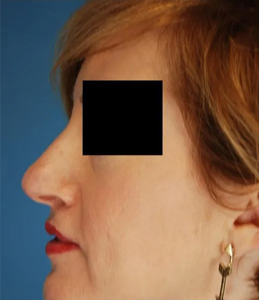 before rhinoplasty female patient left side view case 4874 Crispin Plastic Surgery Atlanta, GA