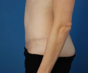 after tummy tuck female patient left side view case 1630