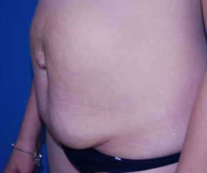 before tummy tuck female patient left angle view case 1630