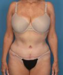 after tummy tuck female patient front view case 1662