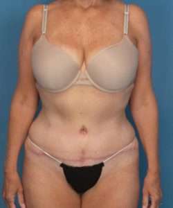 after tummy tuck female patient front view case 1662
