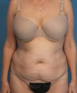 before tummy tuck female patient front view case 1662
