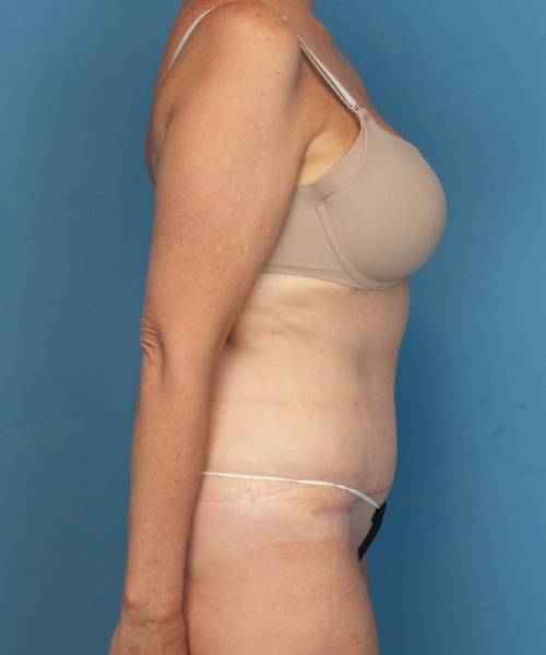 after tummy tuck female patient right side view case 1662
