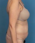 before tummy tuck female patient right side view case 1662