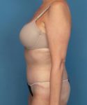 after tummy tuck female patient left side view case 1662