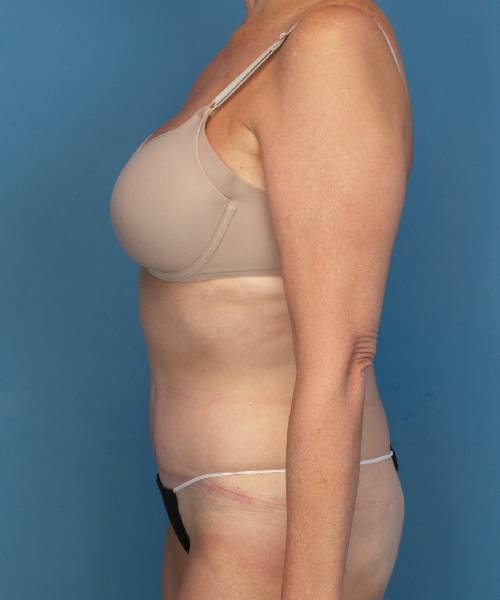 after tummy tuck female patient left side view case 1662