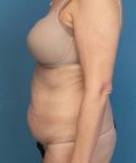 before tummy tuck female patient left side view case 1662