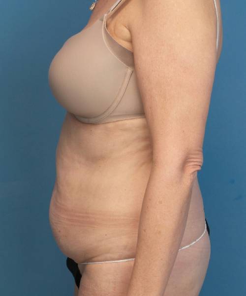 before tummy tuck female patient left side view case 1662