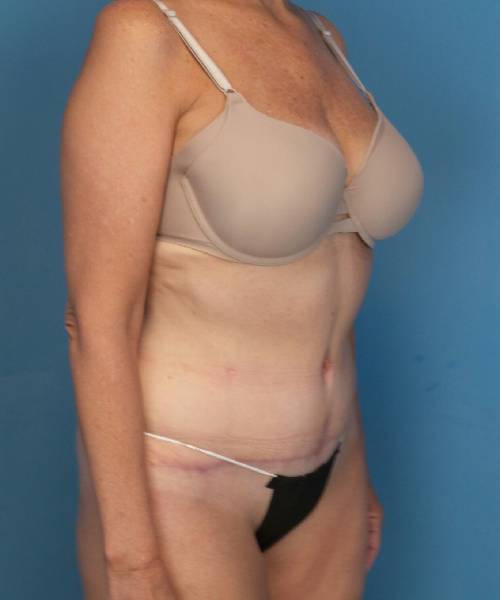 after tummy tuck female patient right angle view case 1662