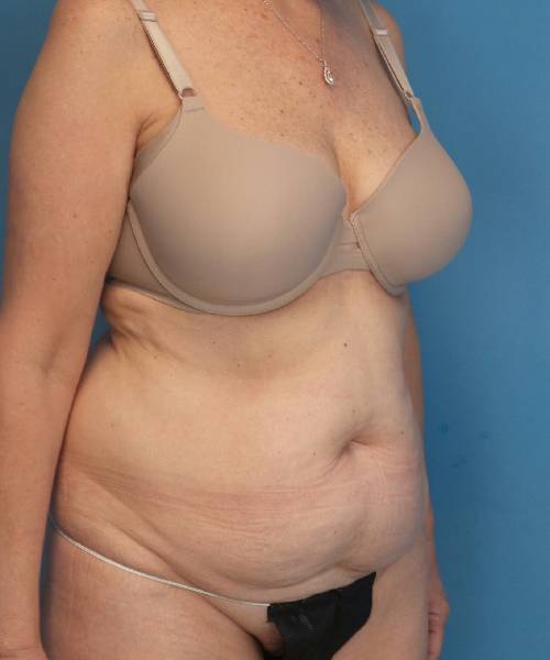 before tummy tuck female patient right angle view case 1662