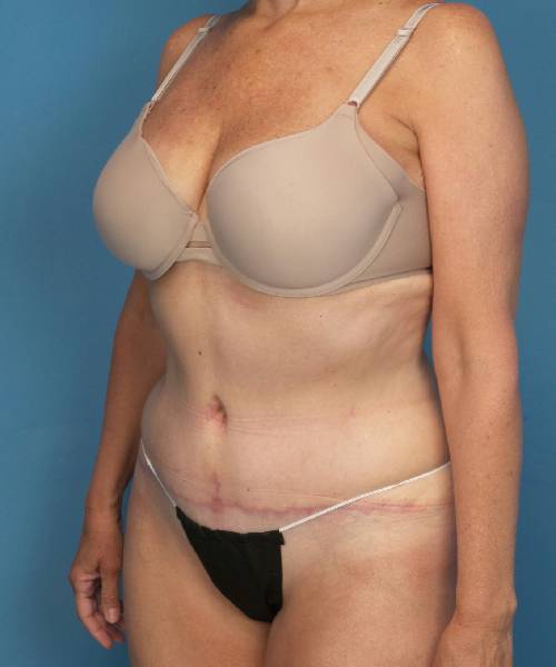 after tummy tuck female patient left angle view case 1662