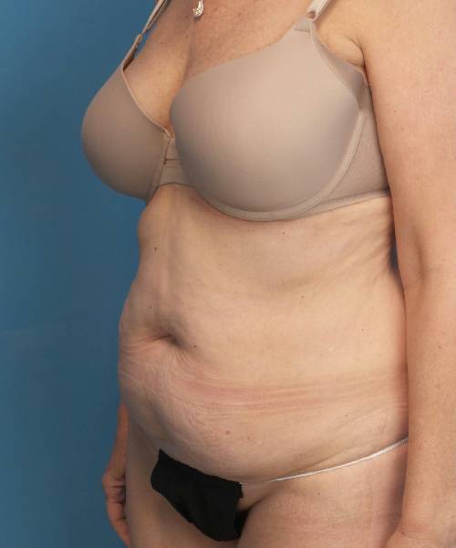 before tummy tuck female patient left angle view case 1662