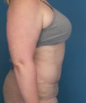 after tummy tuck female patient right side view case 1694