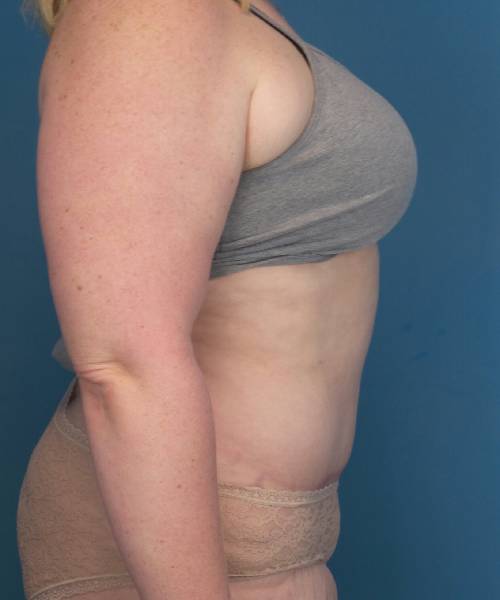after tummy tuck female patient right side view case 1694
