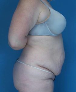 before tummy tuck female patient right side view case 1694