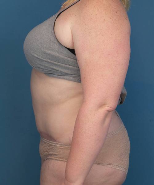 after tummy tuck female patient left side view case 1694