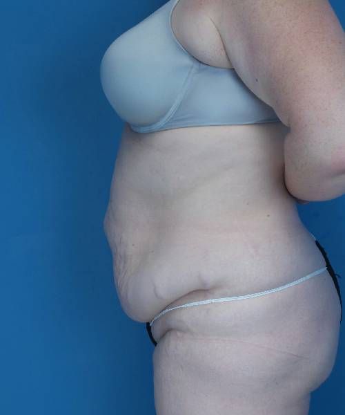 before tummy tuck female patient left side view case 1694