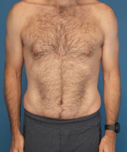 after tummy tuck male patient front view case 1704