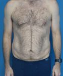before tummy tuck male patient front view case 1704